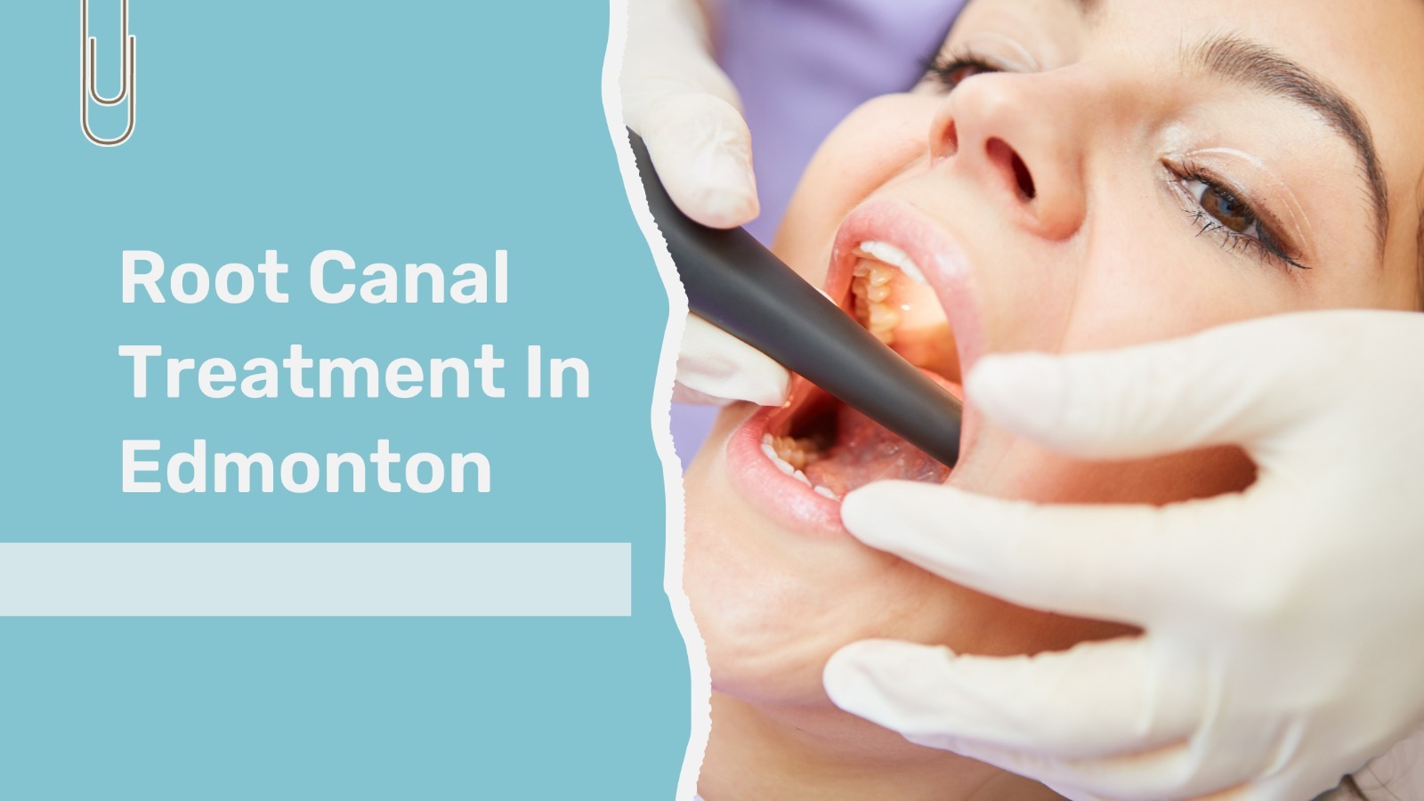 Common Myths and Misconceptions About Root Canals: Separating Fact from Fiction